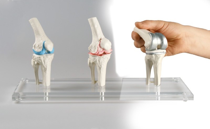 Erler-Zimmer Knee Joint Models